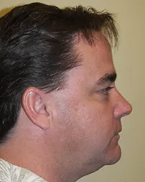 Surgical Orthodontics Teeters Orthodontics in Peoria, AZ