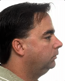 Surgical Orthodontics Teeters Orthodontics in Peoria, AZ