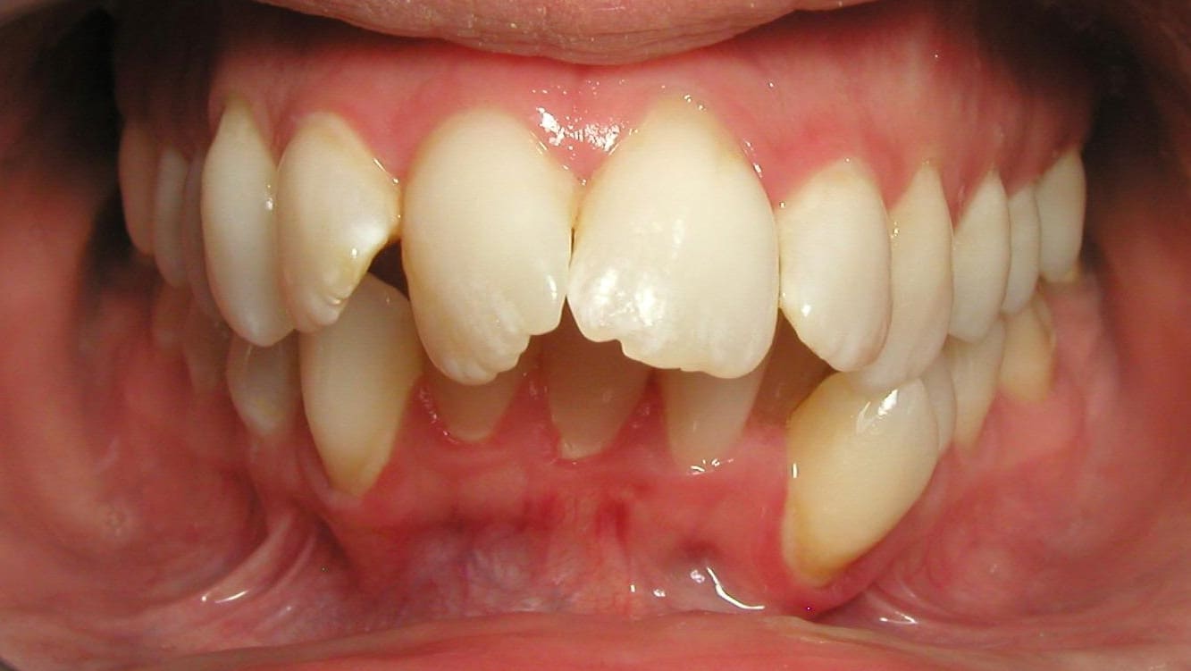 Before Orthodontic Treatment Teeters Orthodontics in Peoria, AZ